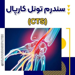 سندرم تونل كارپال (CTS)